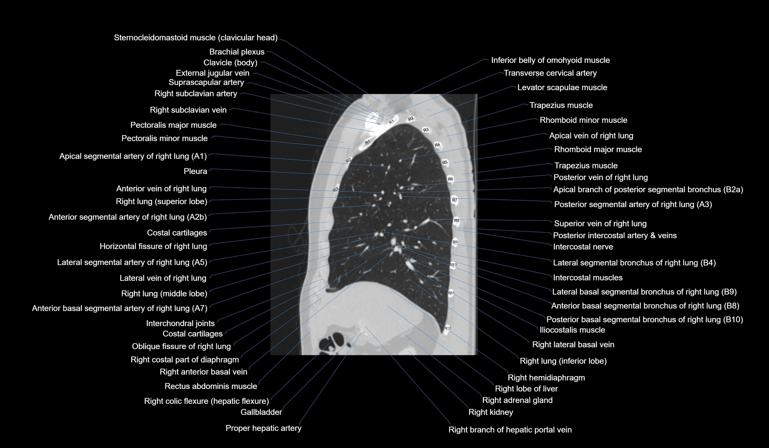 CT chest (thorax) lung window labelled sagittal cross sectional anatomy radiology image-00050.webp